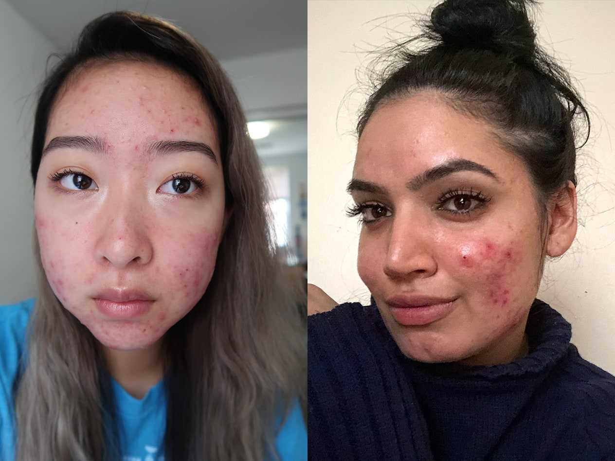 6 YouTube Beauty Stars Share the Advice That Helped Them Deal With Cystic Acne